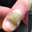Infeccção após roer unhas 